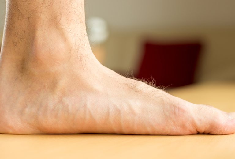 Pies planos causas síntomas y tratamiento